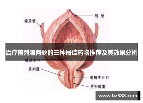 治疗前列腺问题的三种最佳药物推荐及其效果分析