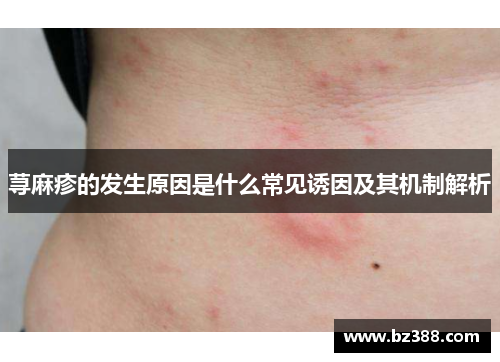 荨麻疹的发生原因是什么常见诱因及其机制解析 荨麻疹的发生原因是什么常见诱因及其机制解析